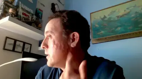 ماوریسو هوئوس جای زخم بر گونهاش که از حملهٔ کوسه گالاپاگوس باقی مانده است را نشان میدهد