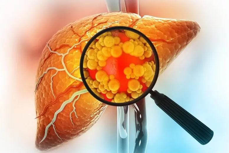 ذرهبین نشانگر کبد بیمار
