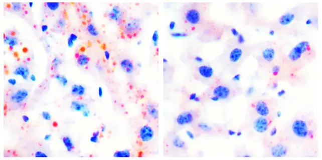 تصویر بیماری کبد